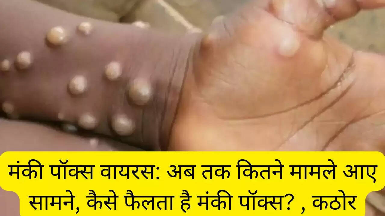 मंकी पॉक्स वायरस: अब तक कितने मामले आए सामने, कैसे फैलता है मंकी पॉक्स? , कठोर